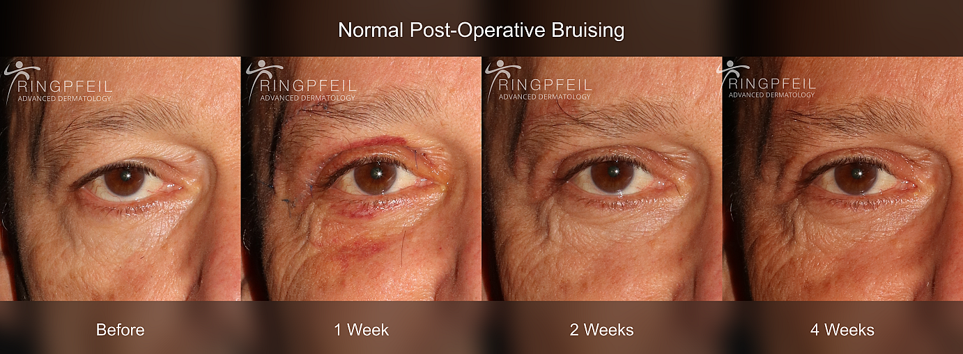 Blepharoplasty before and after