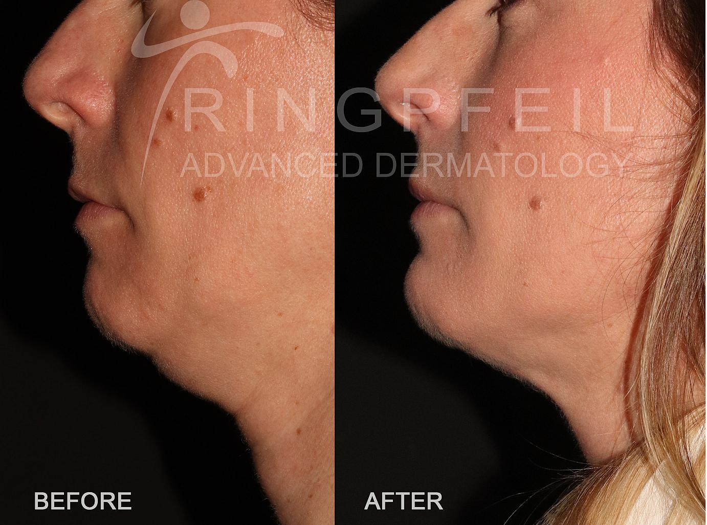 MyEllevate Before and After Left