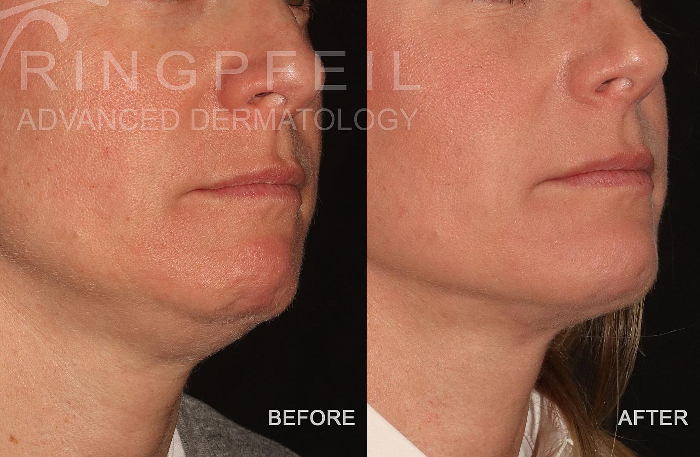 MyEllevate Before and After