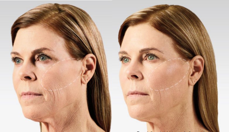 Voluma before and after