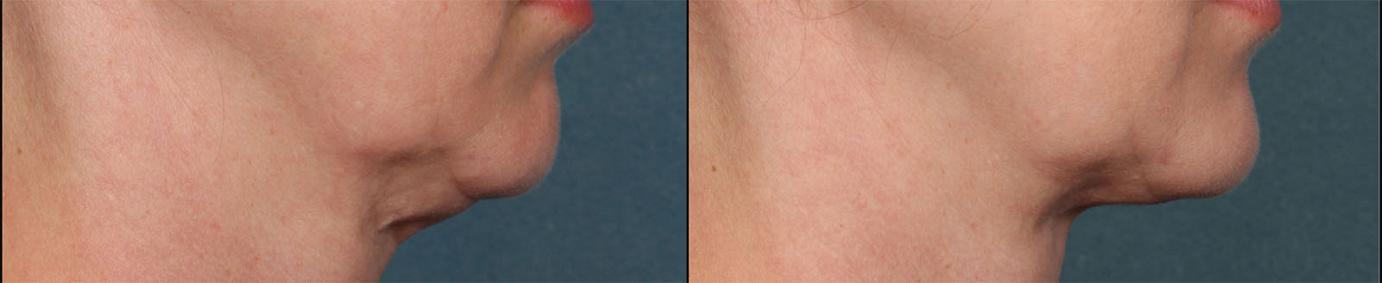 Kybella treatment for dobule chin