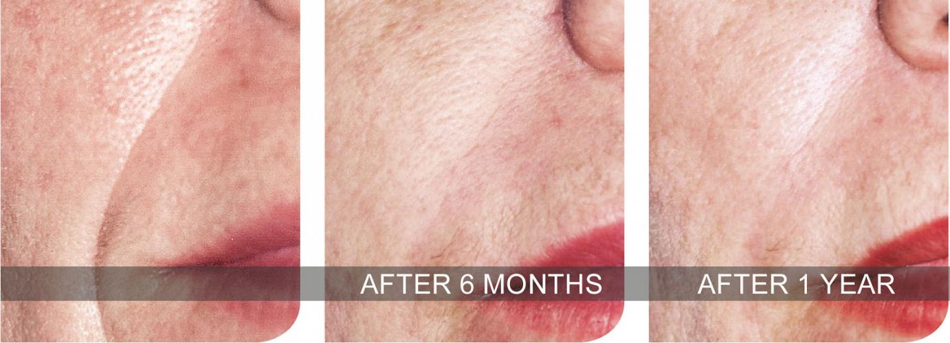 artefill injection in philadelphia