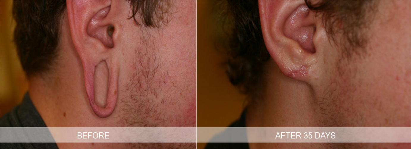 Earlobe Repair Before and After in Philadelphia