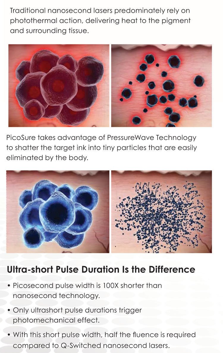 PicoSure&reg; tattoo removal treatment before and after