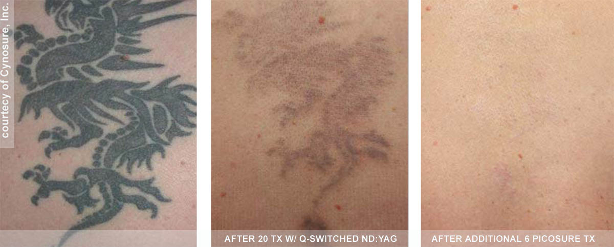 PicoSure&reg; tattoo removal treatment before and after