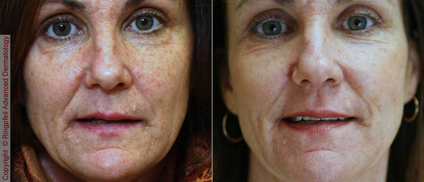 Active FX - before and after